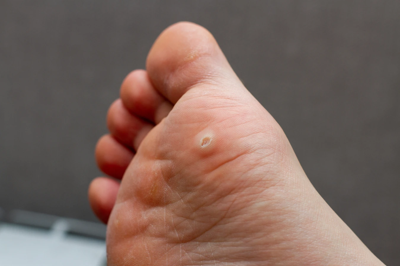 Kurzajki podolog czy dermatolog?